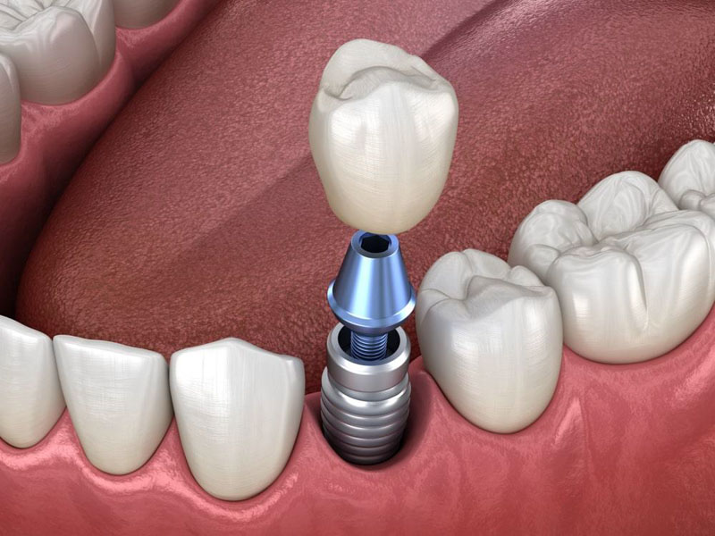 Kỹ thuật trồng răng Implant