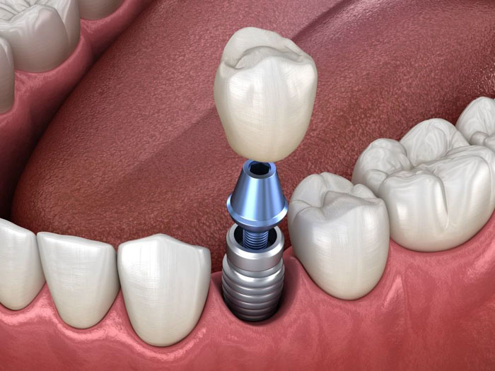 Kỹ thuật trồng răng Implant