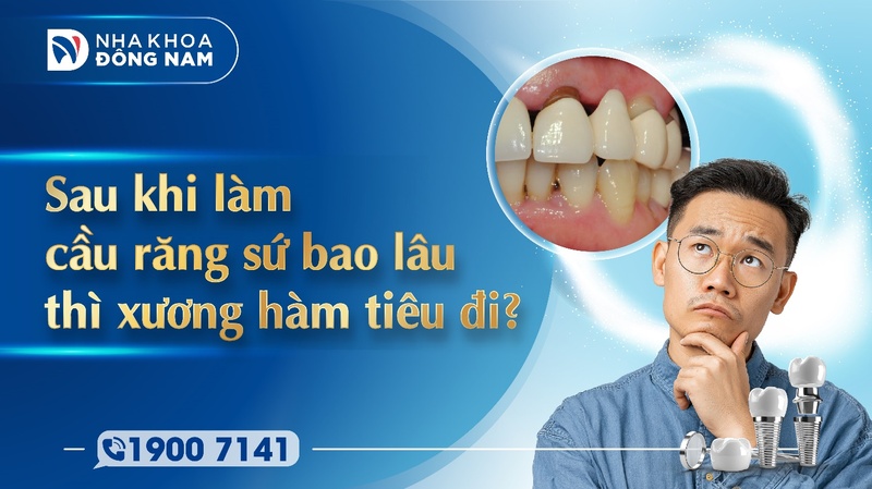 Làm cầu răng sứ bao lâu thì xương hàm tiêu đi