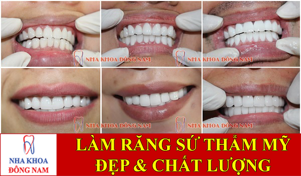 làm răng sứ thẩm mỹ nguyên hàm -1