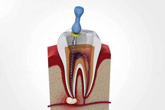 Lấy tủy răng là phương pháp loại bỏ phần tủy bị viêm nhiễm