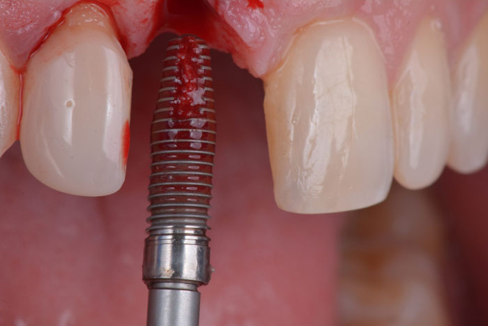 Loại bỏ trụ Implant cũ để đặt trụ Implant mới