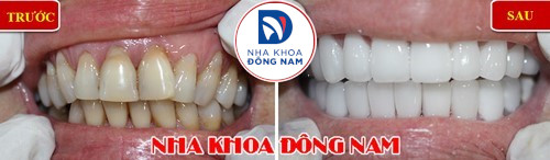 nguyên nhân mòn răng, cách điều trị và phòng ngừa 2