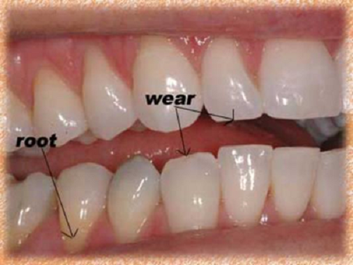 nguyên nhân và cách điều trị mòn răng -2