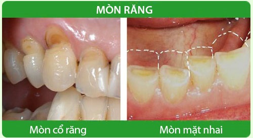 nguyên nhân và cách điều trị mòn răng -4