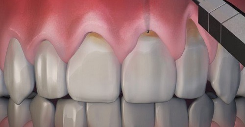 nguyên nhân và cách điều trị mòn răng -5