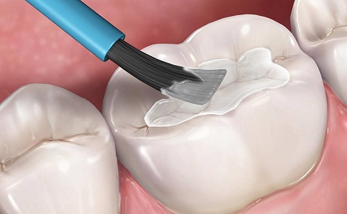 nguyên nhân và cách điều trị mòn răng -6