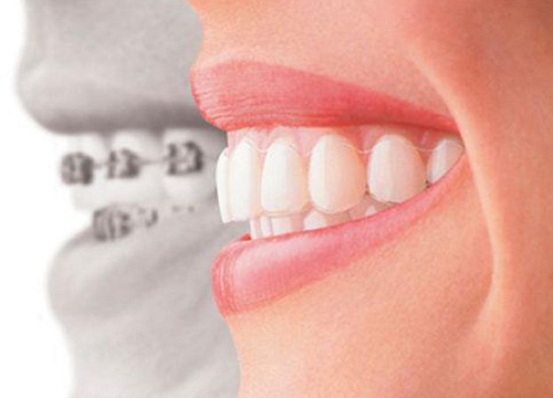 nha khoa chỉnh nha niềng răng tốt nhất tphcm -6
