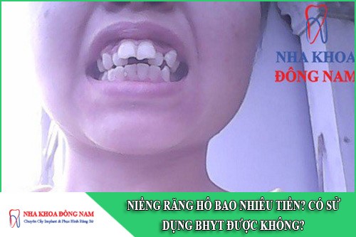 niềng răng hô bao nhiêu tiền