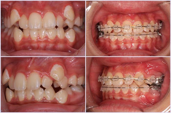 Niềng răng sẽ không cần mài răng giúp bảo tồn răng thật tối ưu