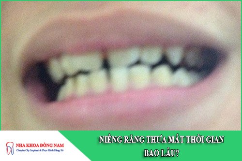 niềng răng thưa mất thời gian bao lâu