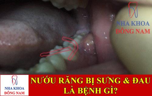 nướu răng bị sưng và đau là bệnh gì -1