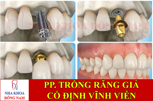 phương pháp trồng răng giả cố định vĩnh viễn -1