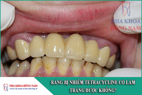răng bị nhiễm tetracycline có làm trắng được không
