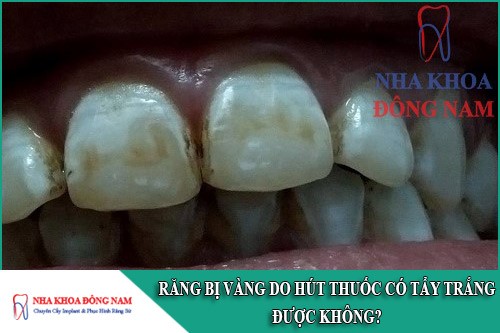 răng bị vàng do hút thuốc có tẩy trắng được không