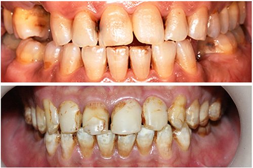 răng bị vàng do hút thuốc có tẩy trắng được không -4