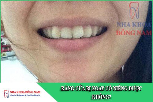 răng cửa bị xoay có niềng được không
