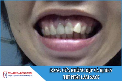 răng cửa không đẹp và bị đen thì phải làm sao
