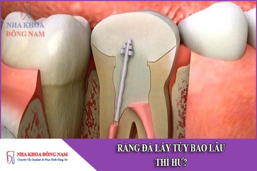 răng đã lấy tủy bao lâu thì hư