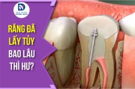 răng đã lấy tủy bao lâu thì hư