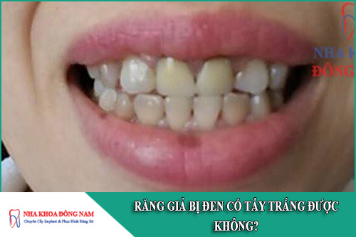 răng giả bị đen có tẩy trắng được không