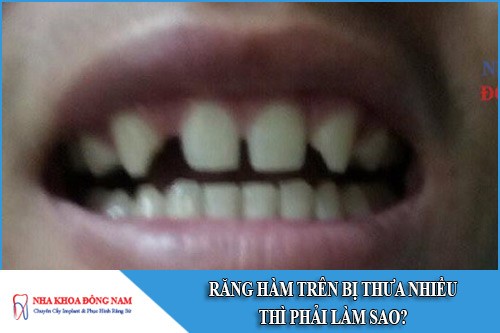 răng hàm trên bị thưa nhiều thì phải làm sao