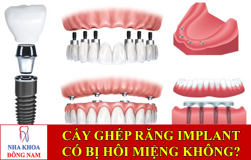 răng implant có bị hôi miệng không -1