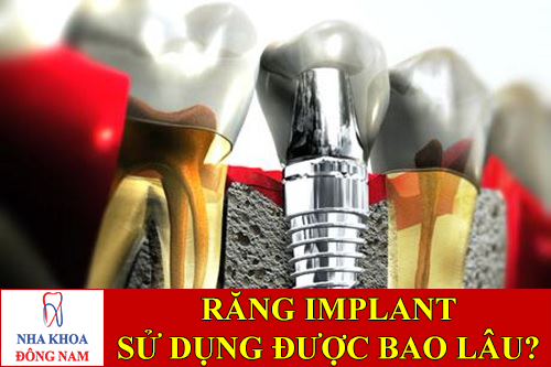 răng implant sử dụng được bao lâu -1