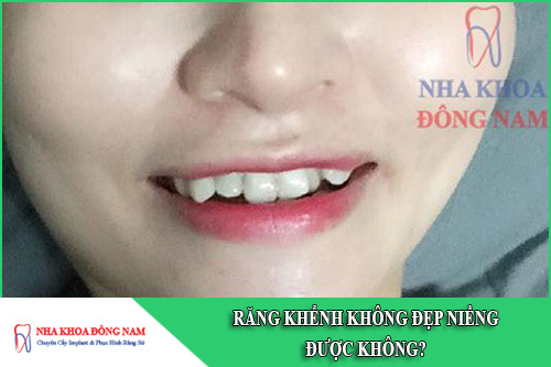 răng khểnh không đẹp niềng được không