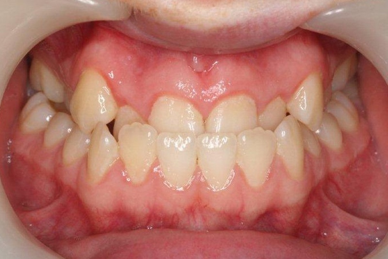 Răng lệch lạc gây tình trạng lệch khớp cắn