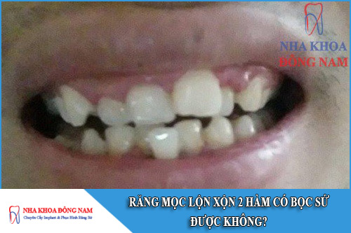 răng mọc lộn xộn 2 hàm có bọc sứ được không