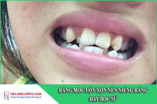 răng mọc lộn xộn nên niềng răng hay bọc sứ