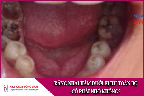 răng nhai hàm dưới bị hư toàn bộ có phải nhổ không