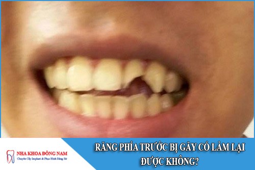 răng phía trước bị gãy có làm lại được không
