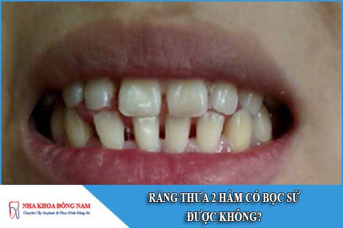 răng thưa 2 hàm có bọc sứ được không