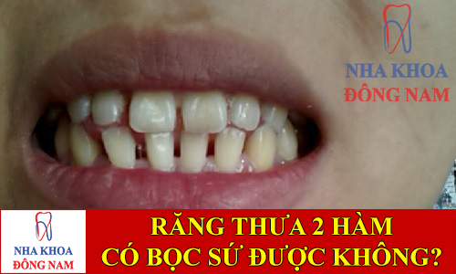 răng thưa 2 hàm có bọc sứ được không -1