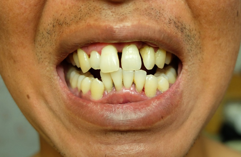 Răng yếu và lệch lạc nghiêm trọng không nên bọc răng sứ