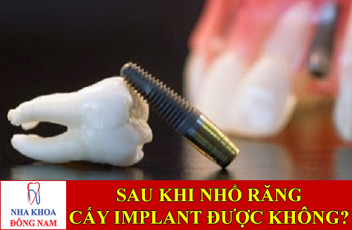 sau khi nhổ răng có cấy ghép implant được không -1