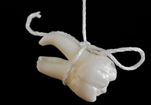 sau khi nhổ răng có cấy ghép implant được không -12