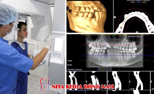 chụp phim CT 3D kiểm tra tình trạng răng và xương hàm