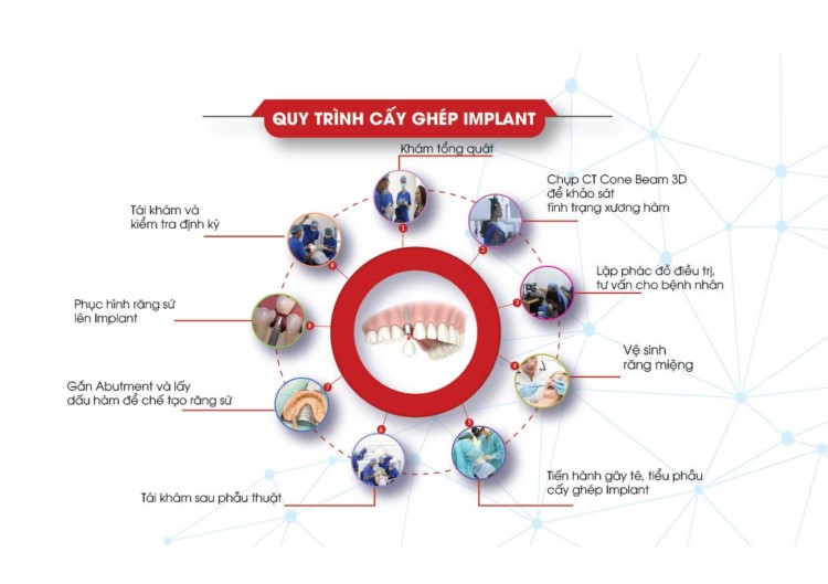 quy trình cấy ghép implant