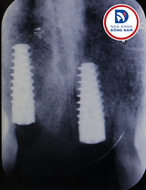 trụ implant trong xương hàm