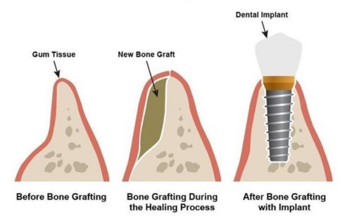 ưu điểm của răng implant