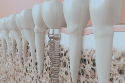 cắm implant không xâm lấn răng bên cạnh