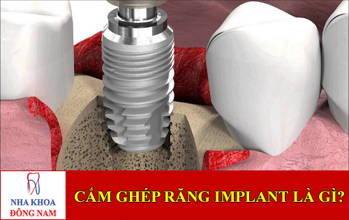 sự thật cắm ghép răng implant là gì -1