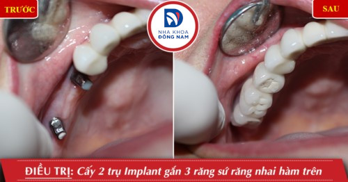 cắm 2 trụ implant răng nhai hàm trên