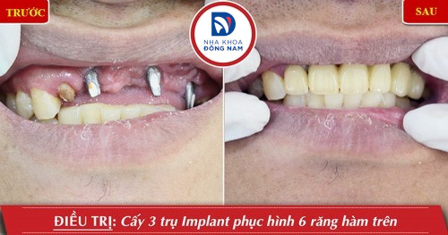 cấy 3 trụ implant răng cửa