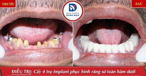 cắm implant và phục hình sứ hàm dưới