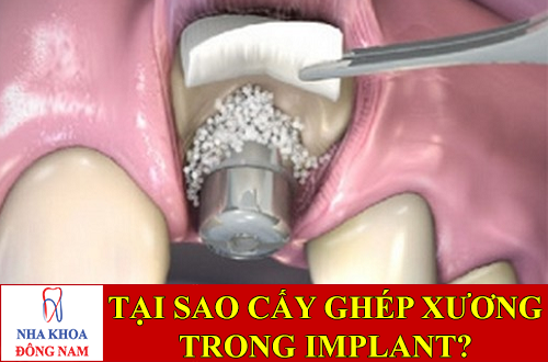 tại sao cần cấy ghép xương trong implant -2