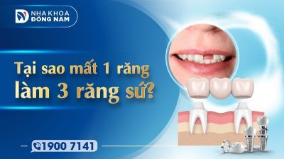 Tại sao mất 1 răng làm 3 răng sứ